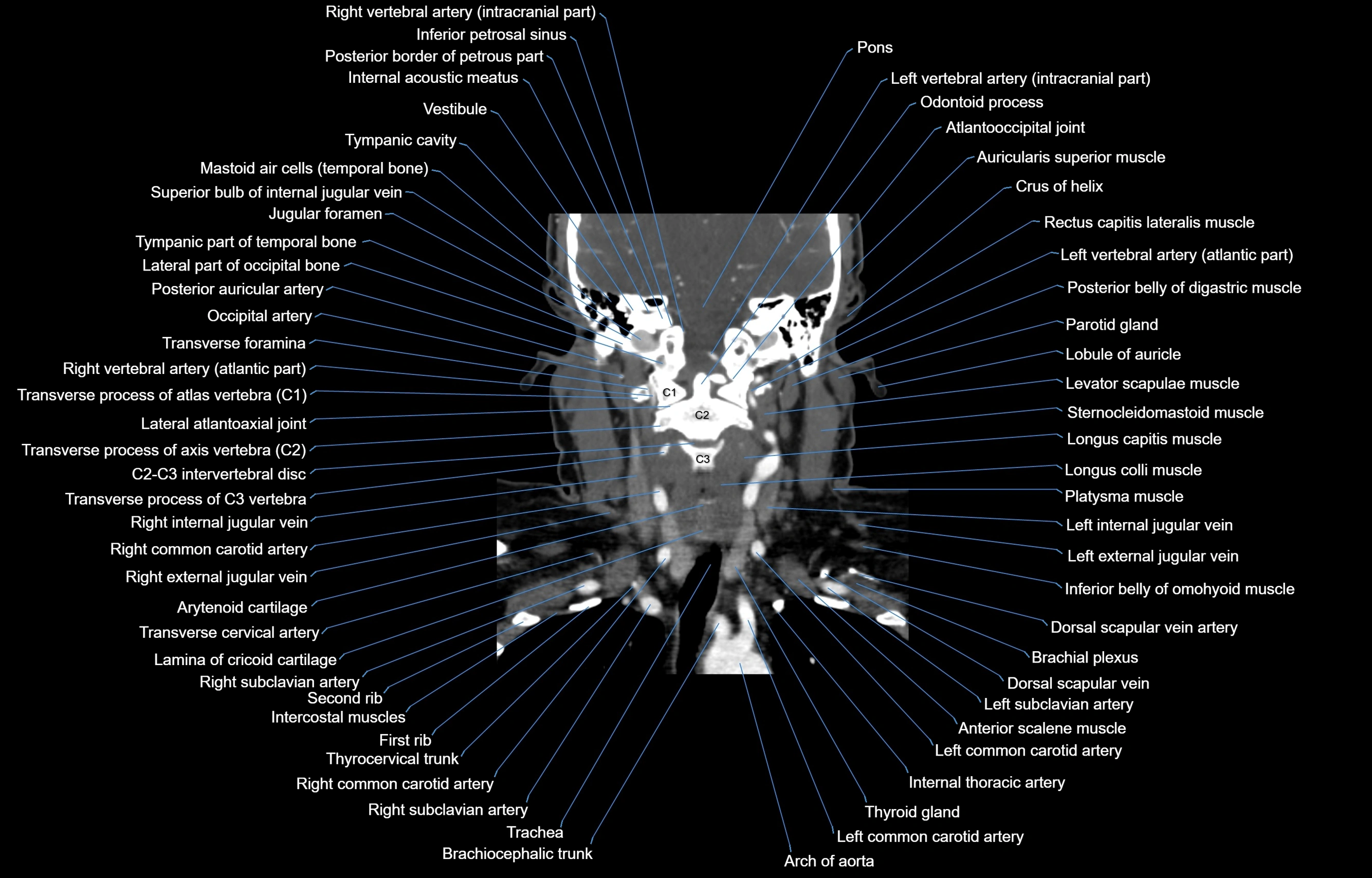 CT Neck coronal  cross sectional anatomy labelled 3D  radiology  image-00039.webp